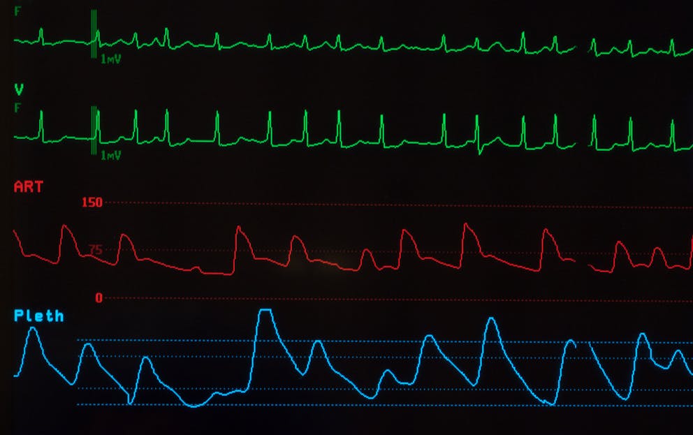 can-low-vitamin-d-cause-heart-palpitations-dr-berg