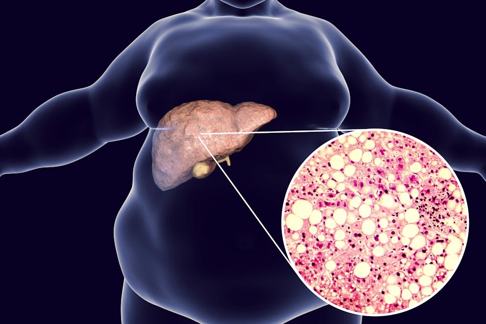 Non-alcoholic fatty liver illustration