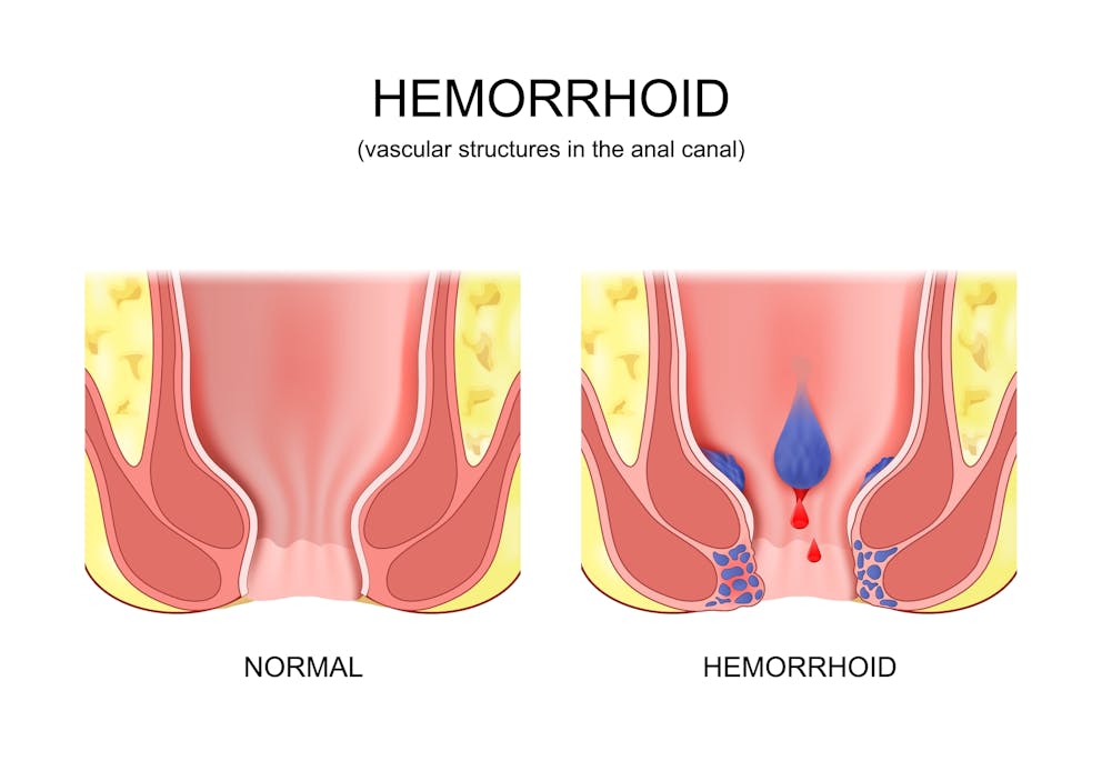Hemorrhoid illustration
