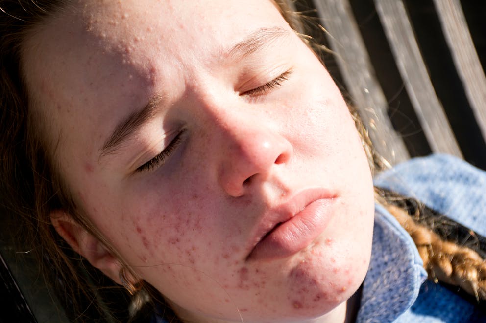 Teenage girl with acne vulgaris