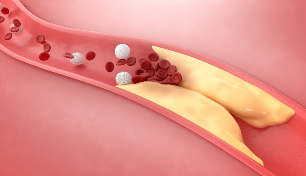 Thickened arteries