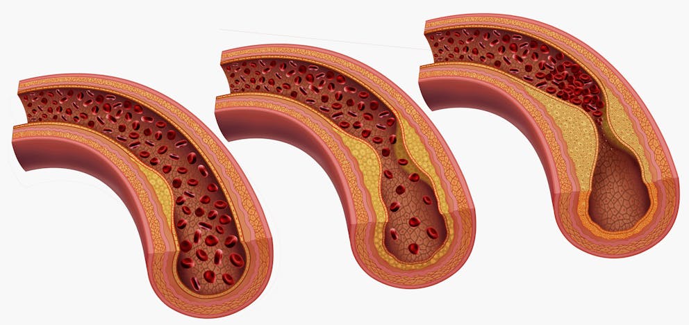 Stages of atherosclerosis