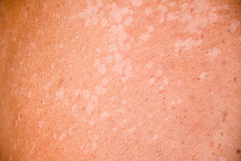 Tinea versicolor on skin