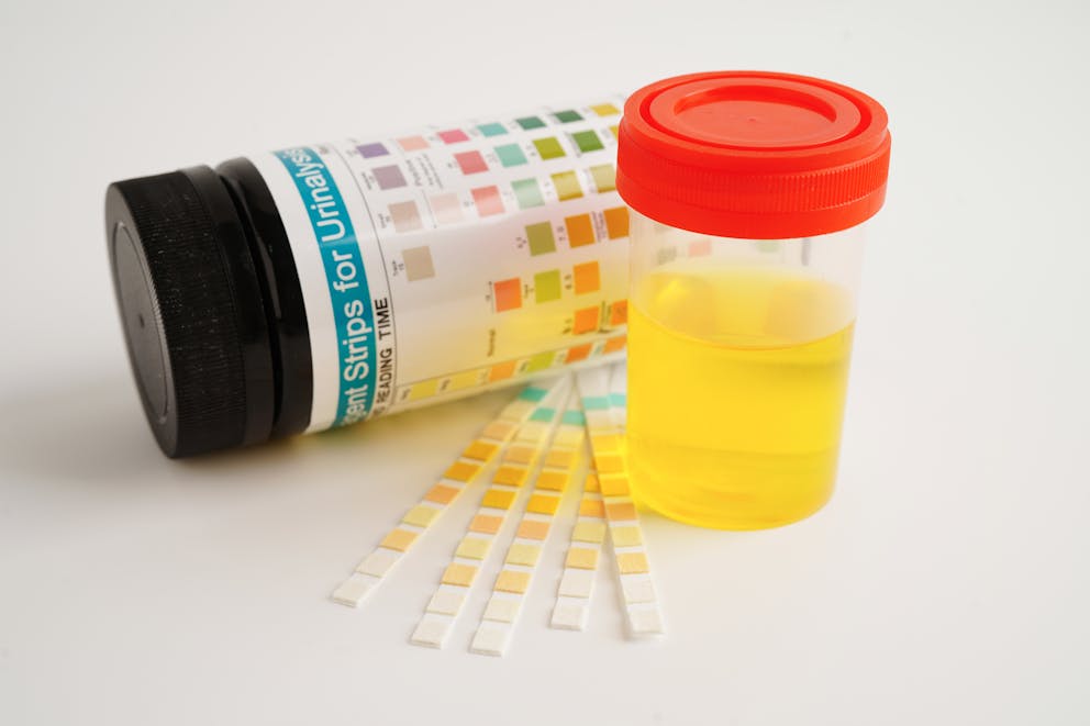 Urinalysis dipstick test strips