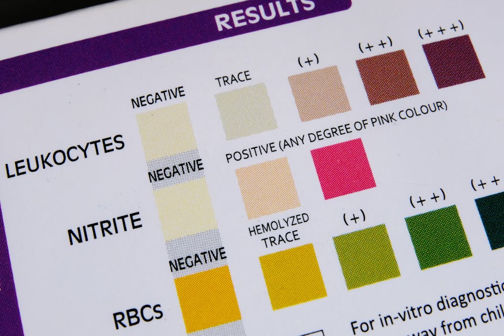 urinalysis test result color chart