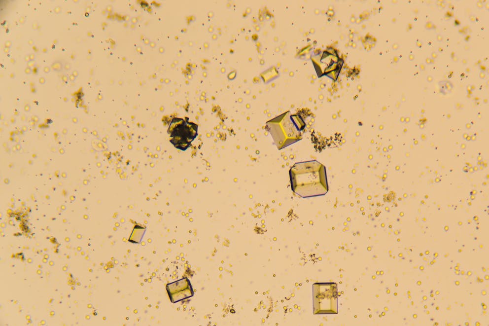 urine crystals under a microscope