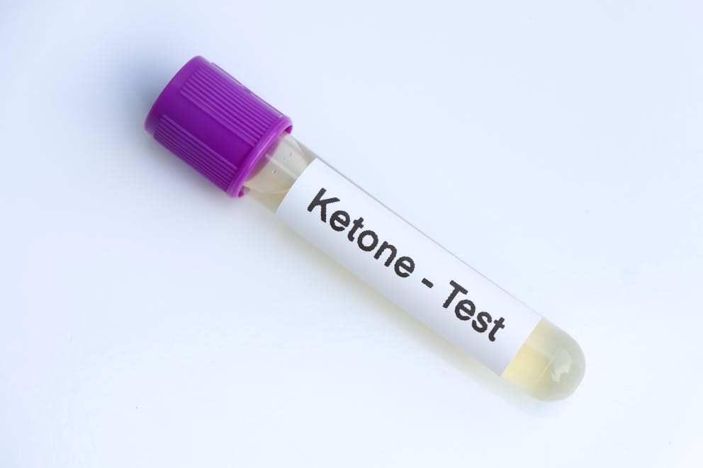 Urine ketone test