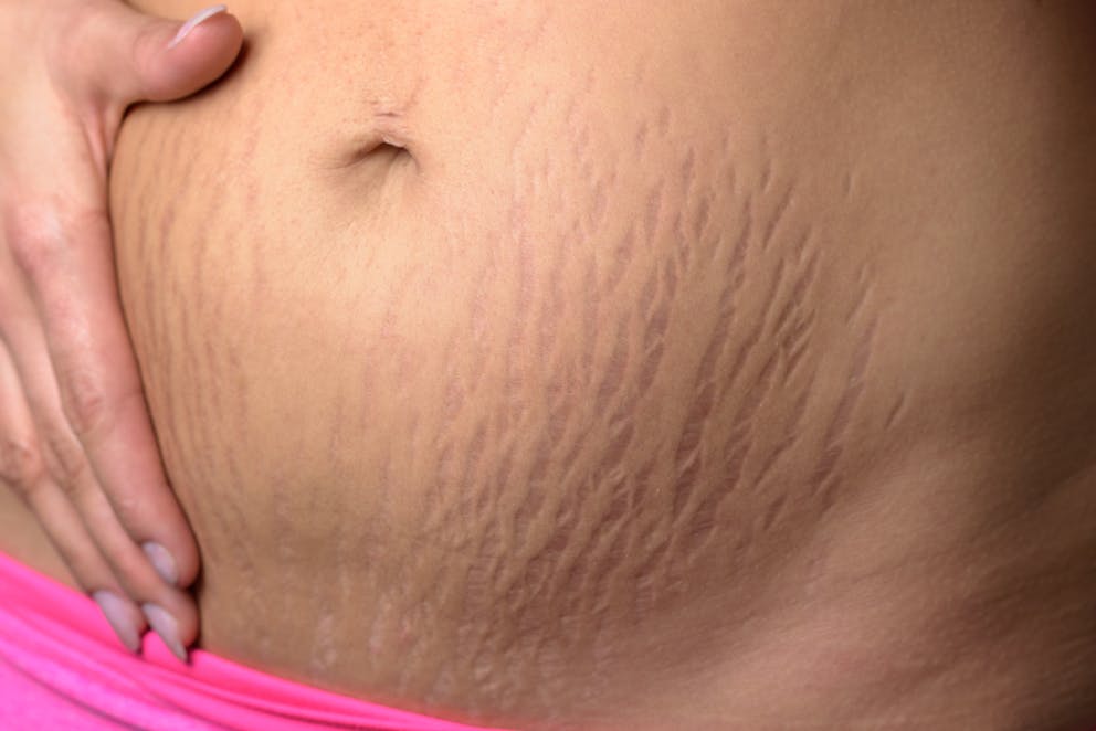Woman with stretch marks