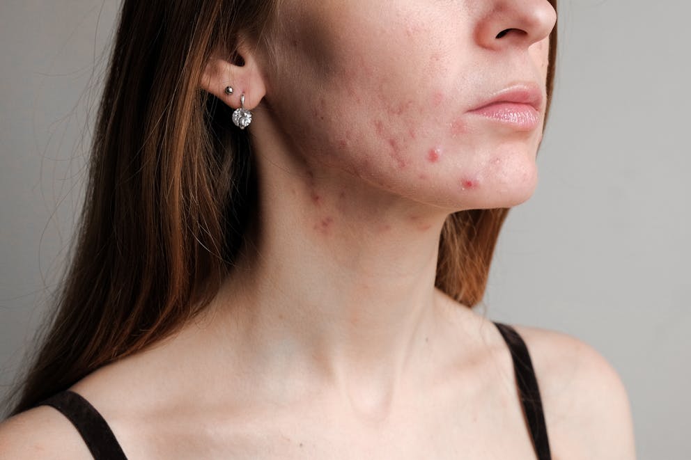 Woman with hormonal acne