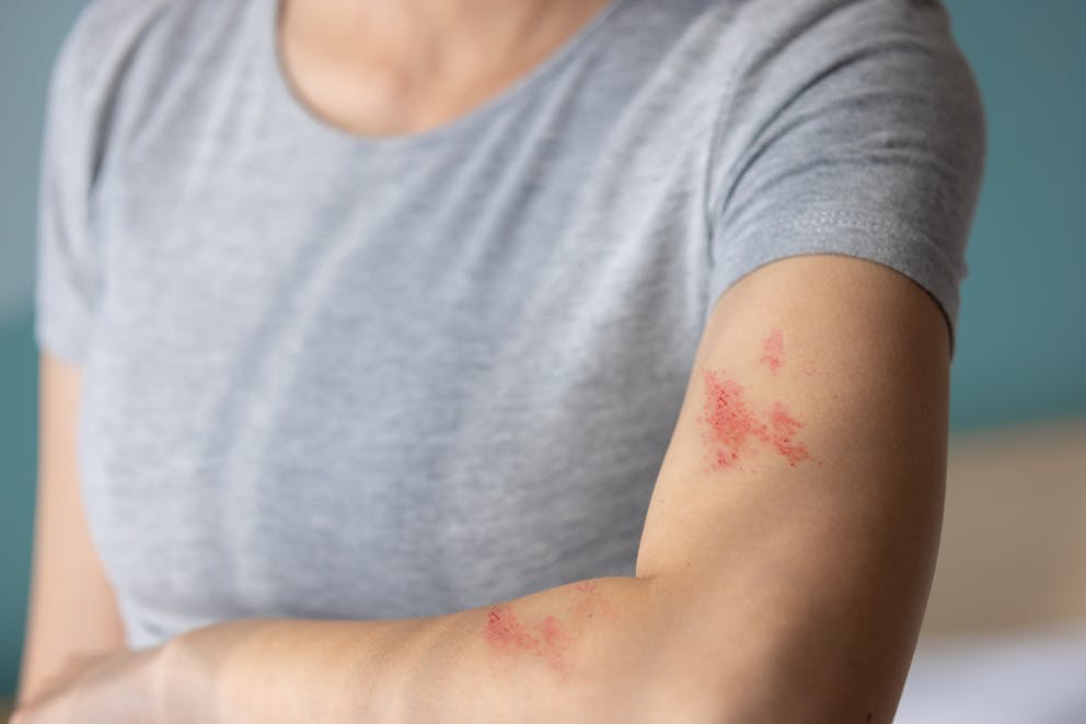 women with shingles rash