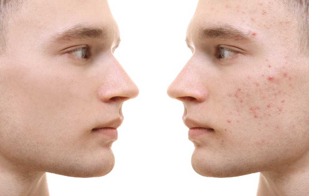Young man before and after acne treatment