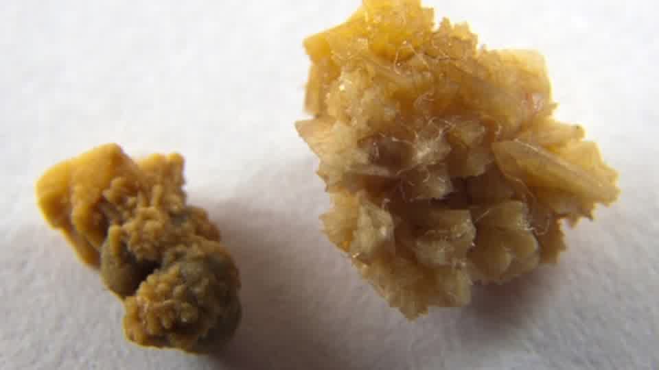 Eliminate Kidney Stones with Lemons | Dr. Berg