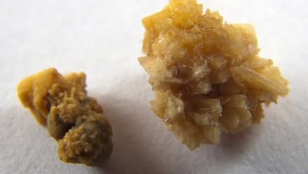 Eliminate Kidney Stones with Lemons | Dr. Berg