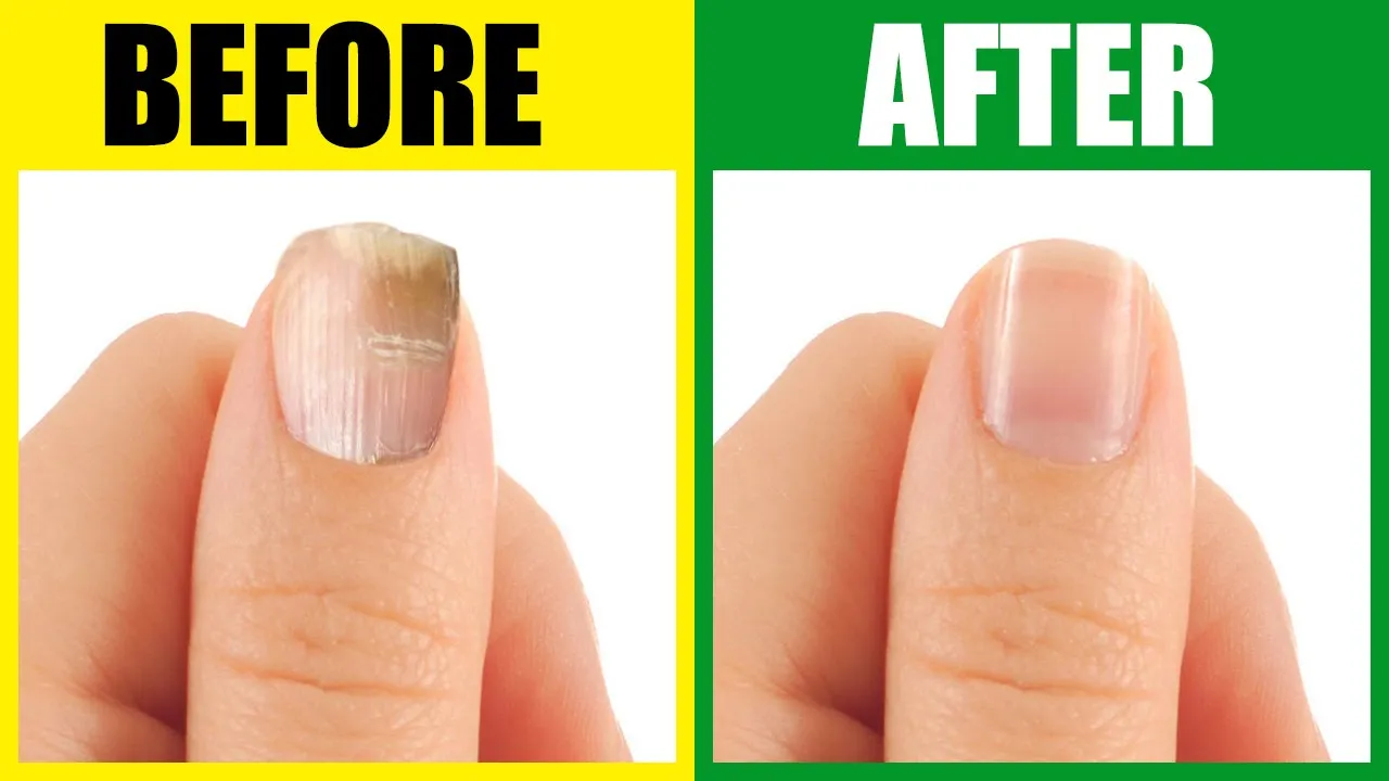 What Do Your Nails Say About Your Health? Signs Of Nutrient Deficiencies -  ReNue Rx