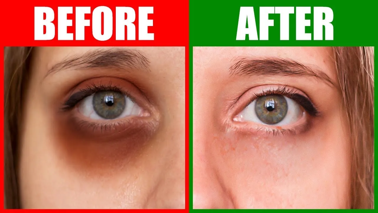 Stryx | Dark Circles Under Eyes Men | Causes & Treatments