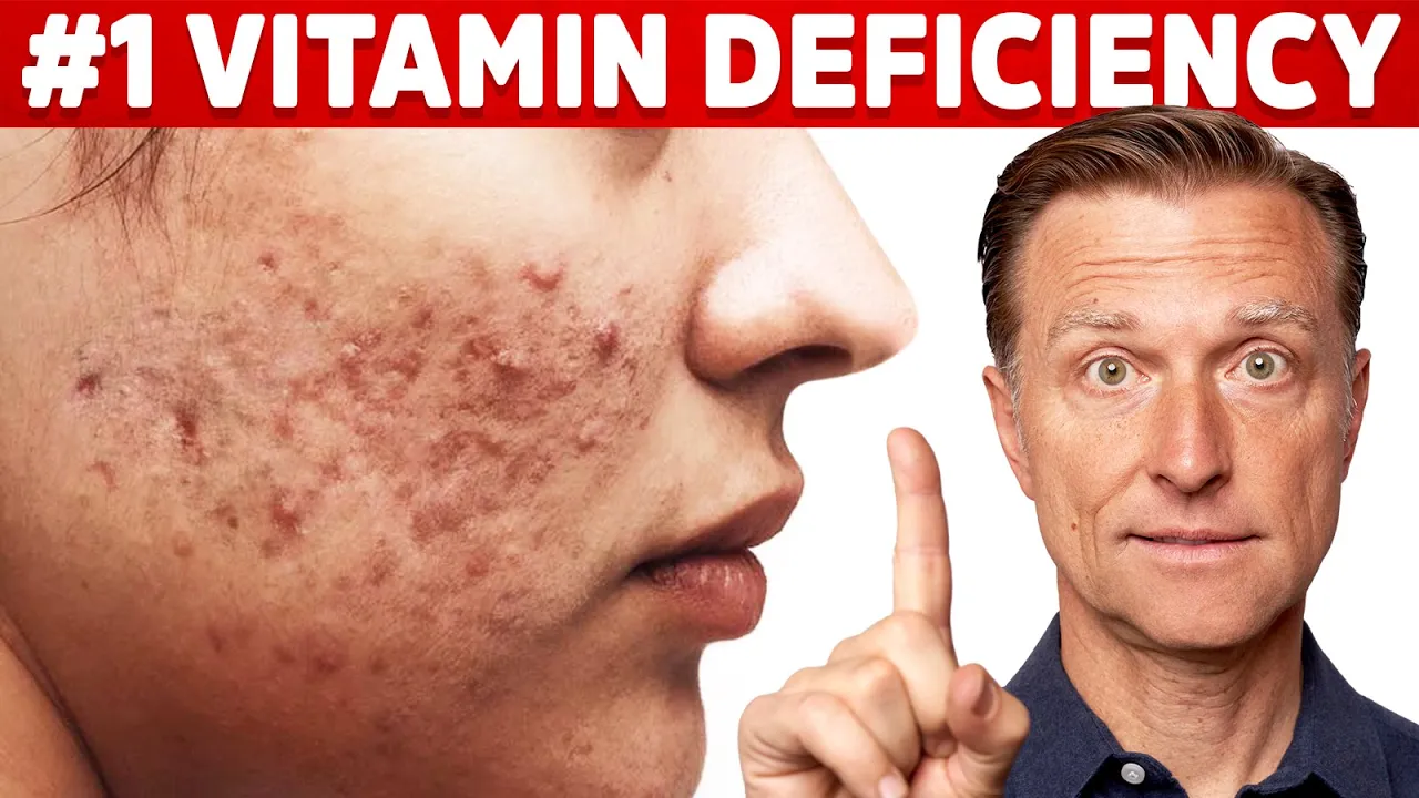 acne-and-vitamin-deficiency-the-top-cause