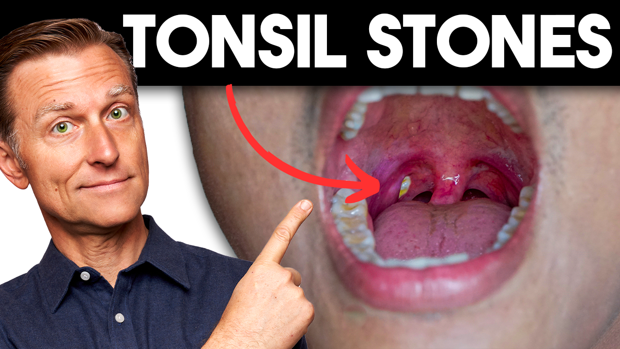 Tonsil Stones Uncover and Remove the Cause